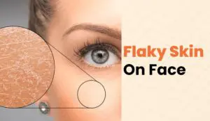 Flaky Skin on Face That Won't Heal